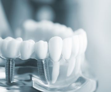 Trồng răng implant
