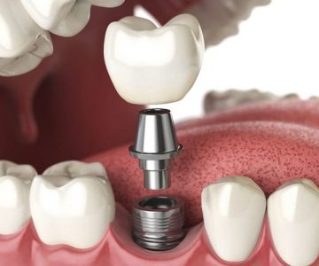 Trồng răng implant