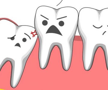 Nhổ răng tại nha khoa Ngân Phượng