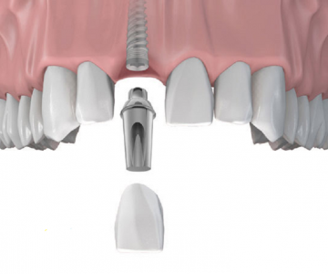 Trồng răng implant