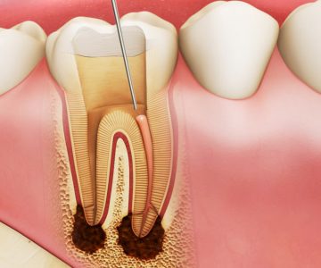 Điều trị tủy răng