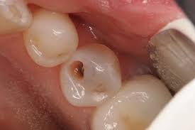 Điều trị tủy răng