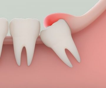 Nhổ răng tại nha khoa Ngân Phượng