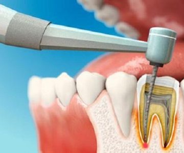 Nhổ răng tại nha khoa Ngân Phượng