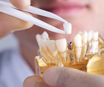 Trồng răng implant