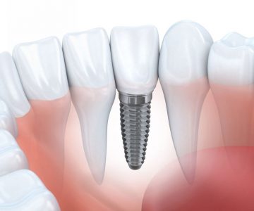 Trồng răng implant