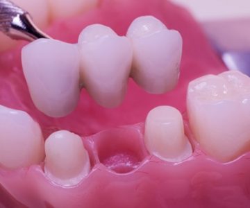 Điều trị tủy răng