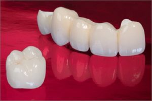 các loại răng sứ