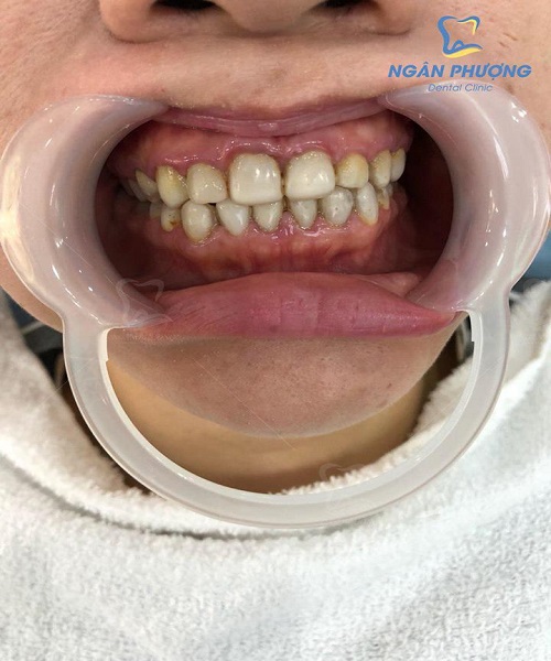 hàm răng ố vàng của một người trưởng thành