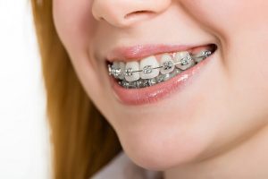 một người đeo niềng răng cười