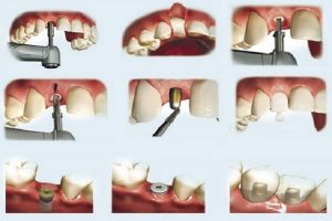 1607327554 6856 rang implant co dau khong 2