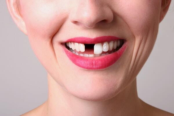 Trồng răng Implant có đau không