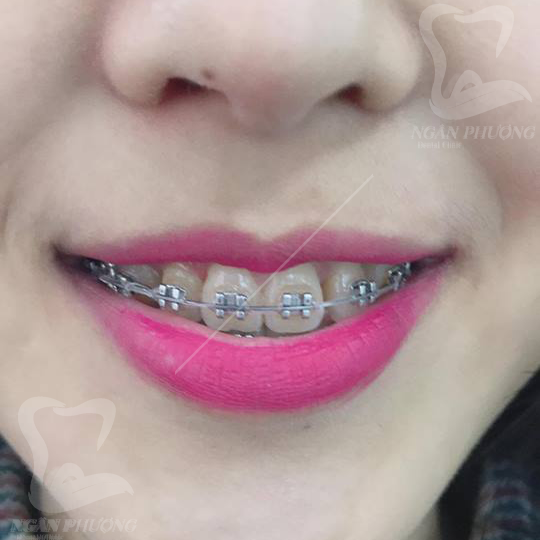 tác dụng của niềng răng đối với nụ cười