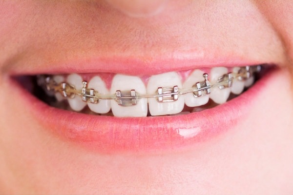hàm răng một người với mắc cài