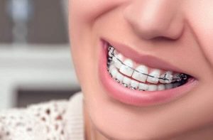 hàm răng một người với mắc cài