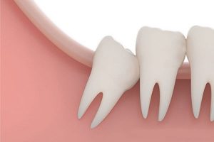 mô phỏng răng số 8 đâm vào thân răng số 7