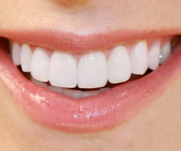 Răng sứ thẩm mỹ