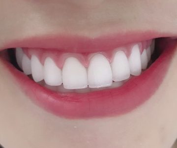 Răng sứ thẩm mỹ