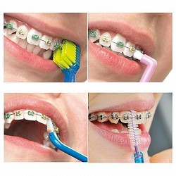 Chăm Sóc Răng Sau Niềng Răng Như Thế Nào