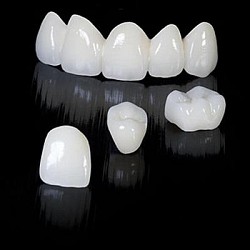 Dán răng sứ Veneer là gì?
