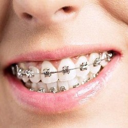 Niềng Răng Mắc Cài là gì?