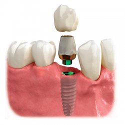 Trồng Răng Implant Có Đau Không