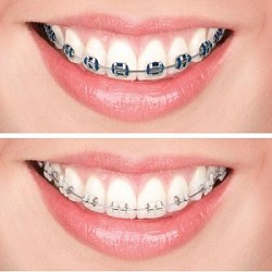Niềng Răng Bao Nhiêu Tiền 2025? Chi Phí Niềng Tại Nha Khoa Ngân Phượng