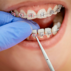 Quy Trình Niềng Răng – Niềng Thế Nào Mới Đúng