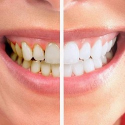 Bọc Răng Sứ Là Gì? Cùng Tìm Hiểu