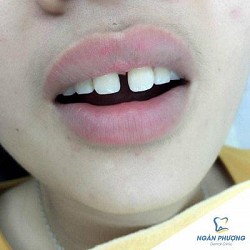 Răng Thưa Làm Thế Nào