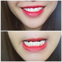Bất Hạnh Vì Răng Xấu, bị gia đình người yêu phản đối