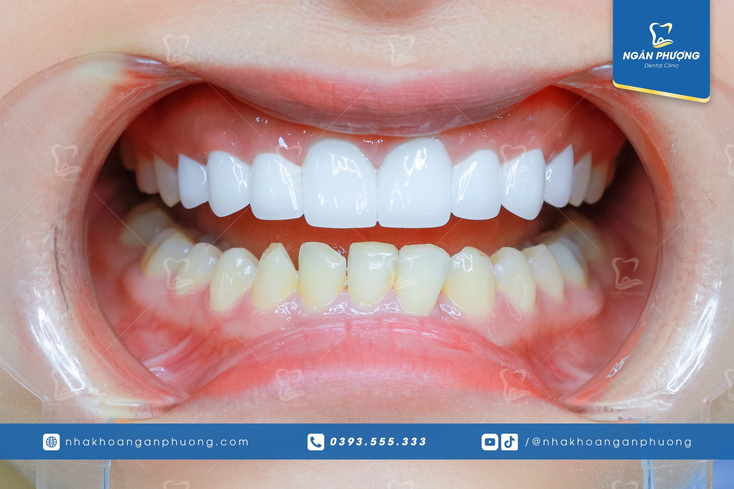 hàm răng của một người với hàm trên đã bọc răng sứ