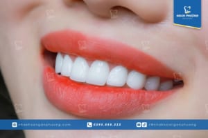 cận miệng cười có răng sứ