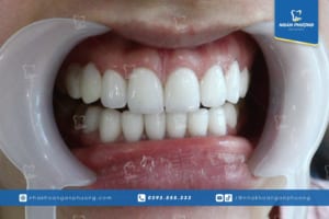 răng sứ giá rẻ