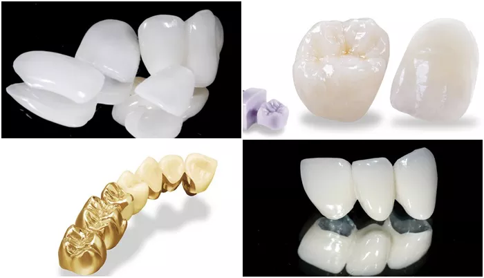 các loại răng sứ thẩm mỹ phổ biến