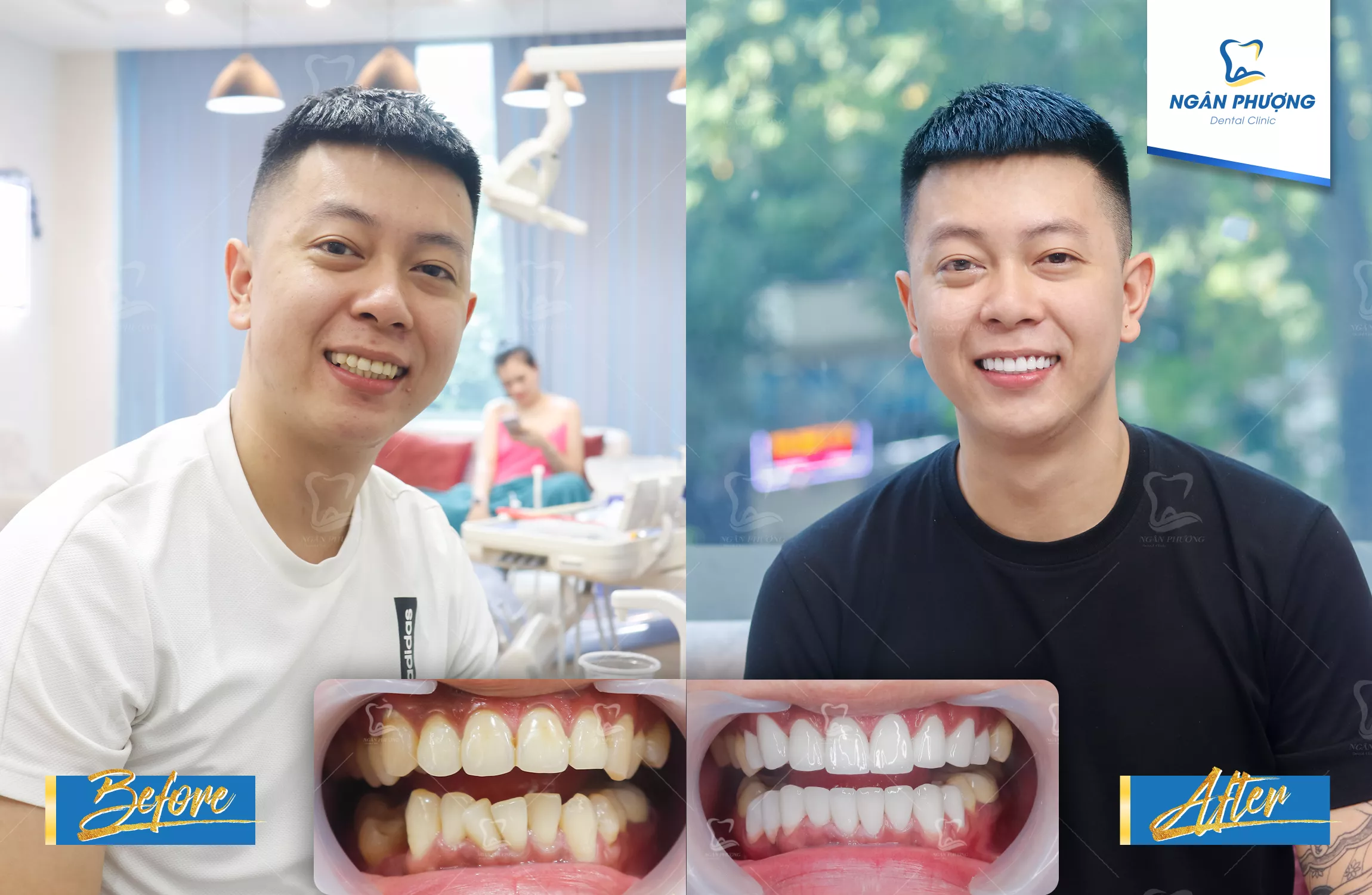 hình ảnh một người nam cười tươi trước và sau khi làm răng sứ