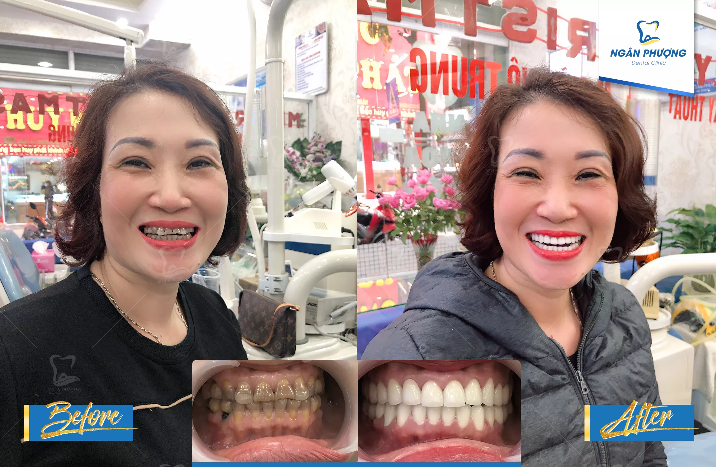 hình ảnh một nữ cười tươi trước và sau khi làm răng sứ