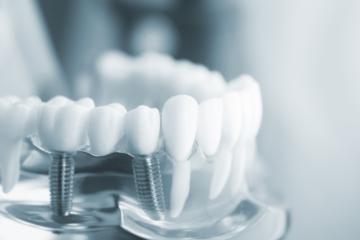 Trồng răng Implant – Phục hình răng bị mất