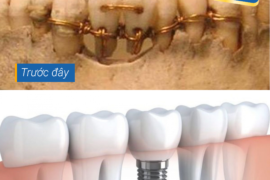 Phục hình răng bị mất xưa và nay | Trồng răng implant