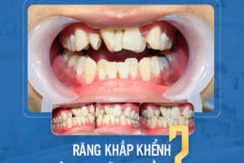 Răng khấp khểnh nên niềng hay bọc sứ?