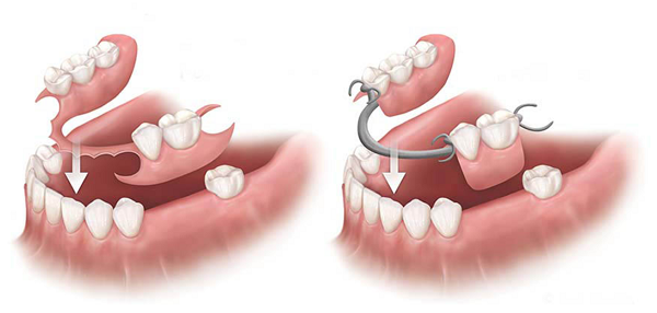 nhược điểm hàm tháo lắp