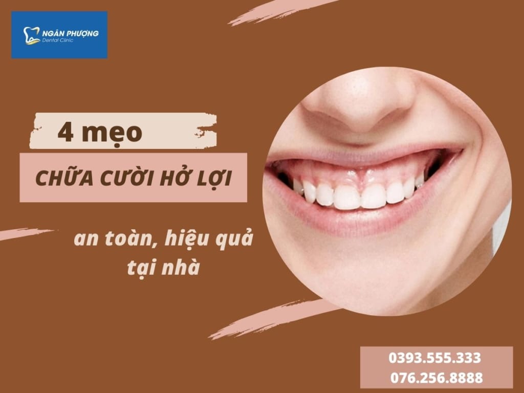 mẹo chữa cười hở lợi an toàn hiệu quả tại nhà