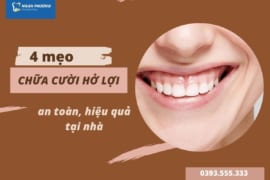 4 MẸO CHỮA CƯỜI HỞ LỢI TẠI NHÀ AN TOÀN