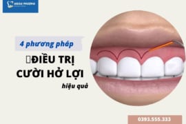 4 PHƯƠNG PHÁP ĐIỀU TRỊ CƯỜI HỞ LỢI ĐẢM BẢO HIỆU QUẢ LÂU DÀI