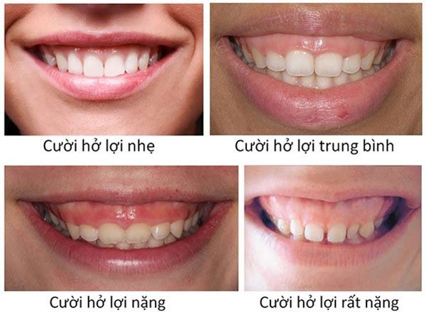 CƯỜI HỞ LỢI LÀ GÌ? - NGUYÊN NHÂN VÀ PHƯƠNG PHÁP ĐIỀU TRỊ - Nha Khoa Ngân  Phượng