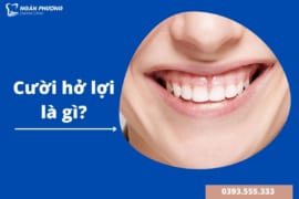 CƯỜI HỞ LỢI LÀ GÌ? – NGUYÊN NHÂN VÀ PHƯƠNG PHÁP ĐIỀU TRỊ