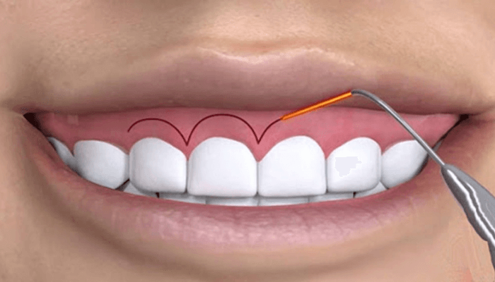 điều trị cười hở lợi