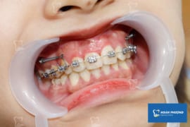 NIỀNG RĂNG BỊ HỞ LỢI – NGUYÊN NHÂN VÀ PHƯƠNG PHÁP ĐIỀU TRỊ