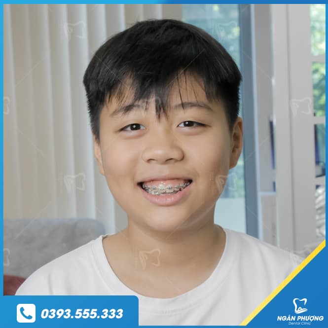 niềng răng điều trị cười hở lợi