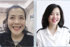 2 PHƯƠNG PHÁP CHỮA CƯỜI HỞ LỢI KHÔNG PHẪU THUẬT